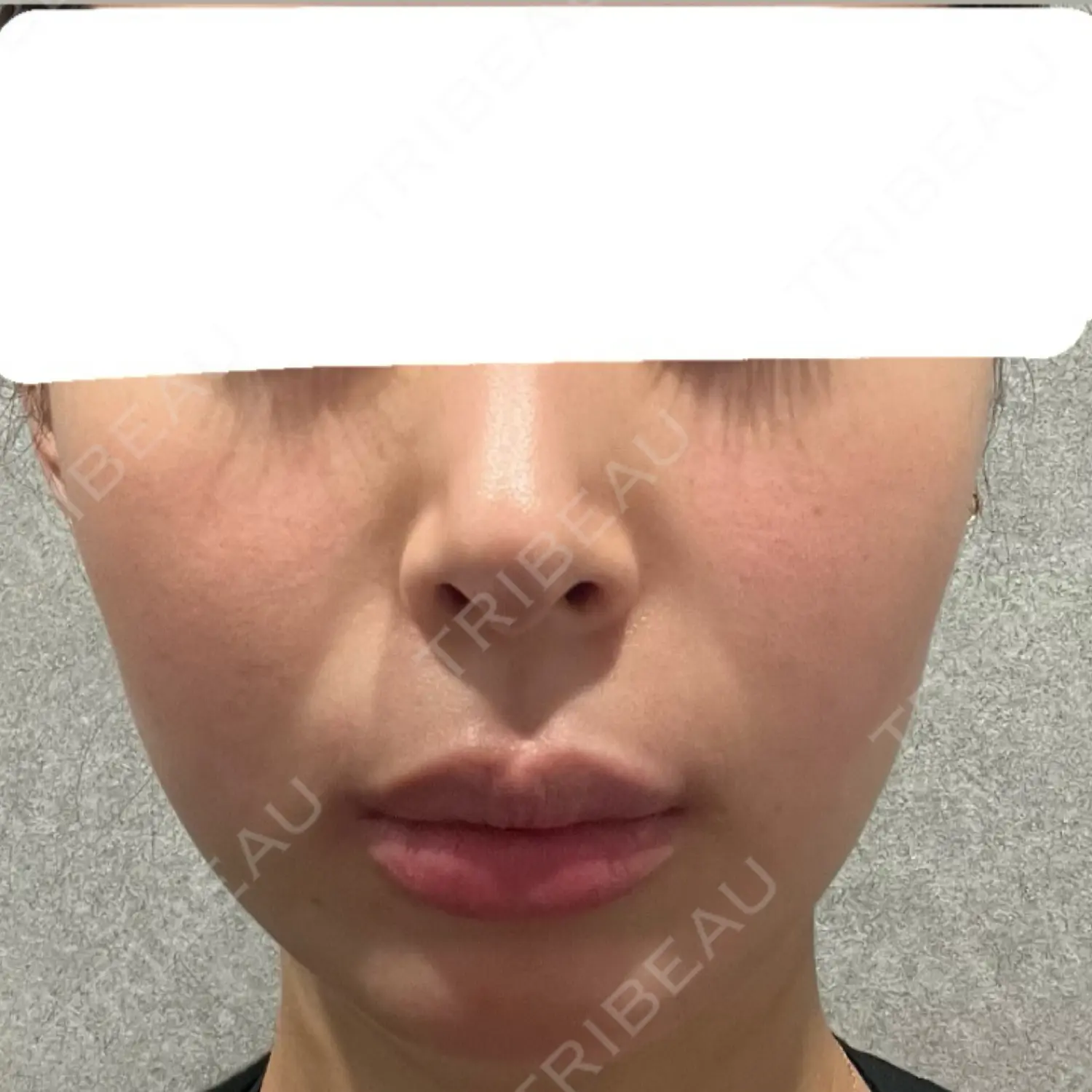 施術前の写真