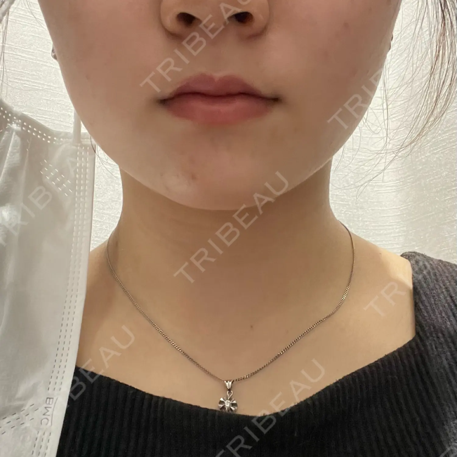 施術前の写真