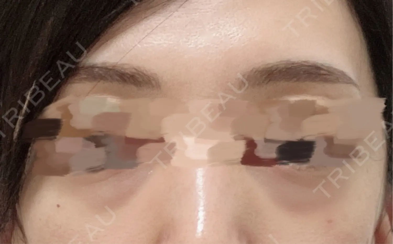 施術前の写真