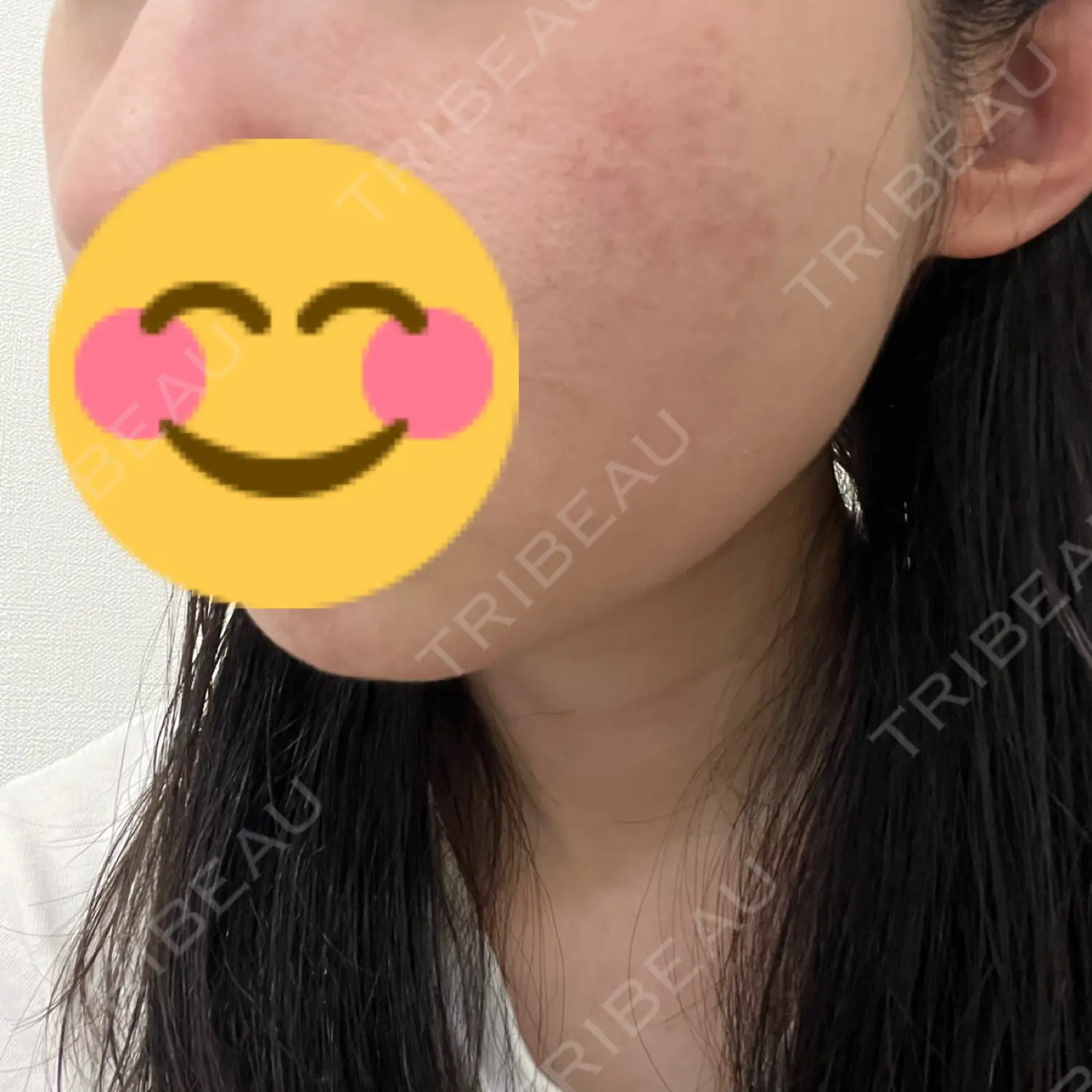 施術前の写真