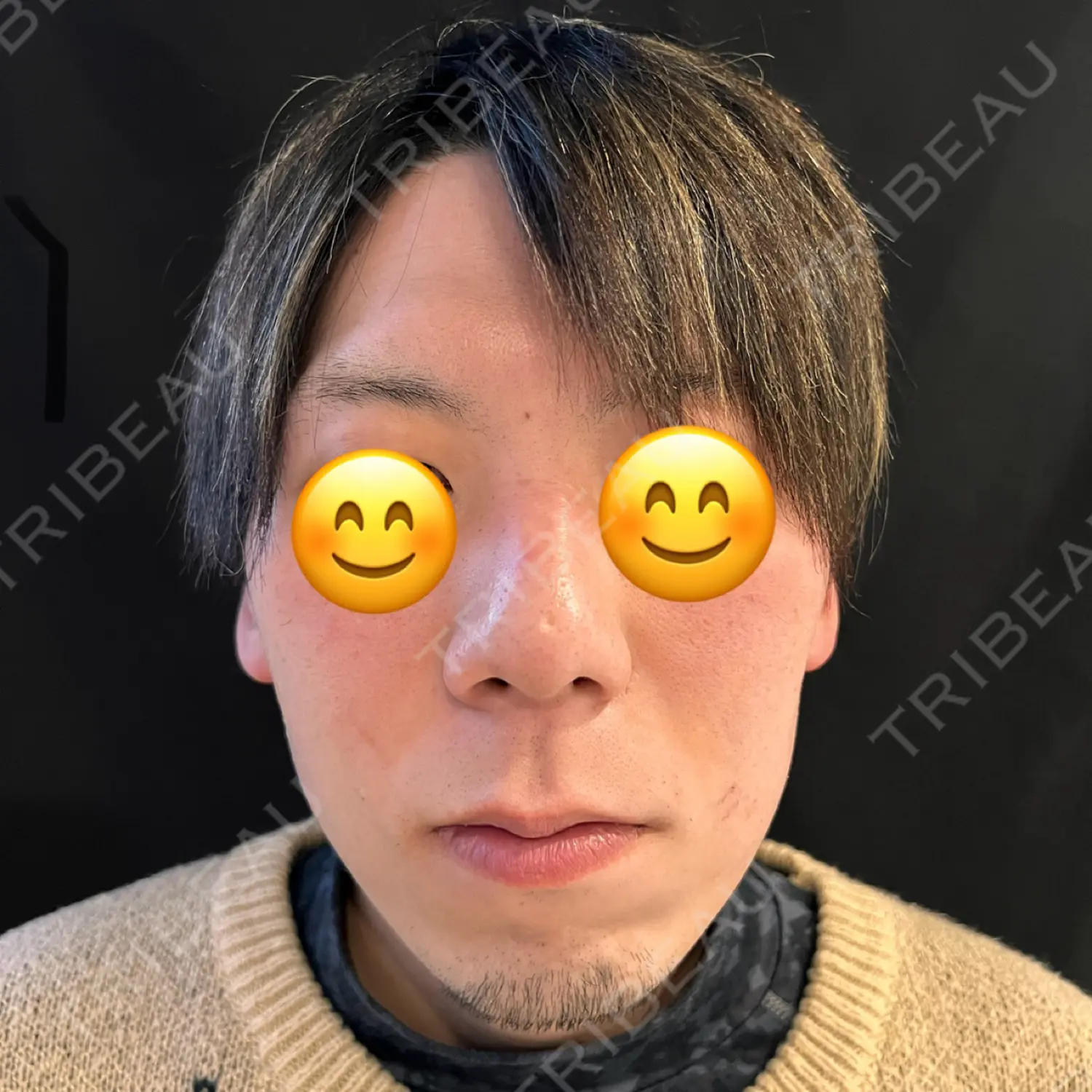 施術前の写真