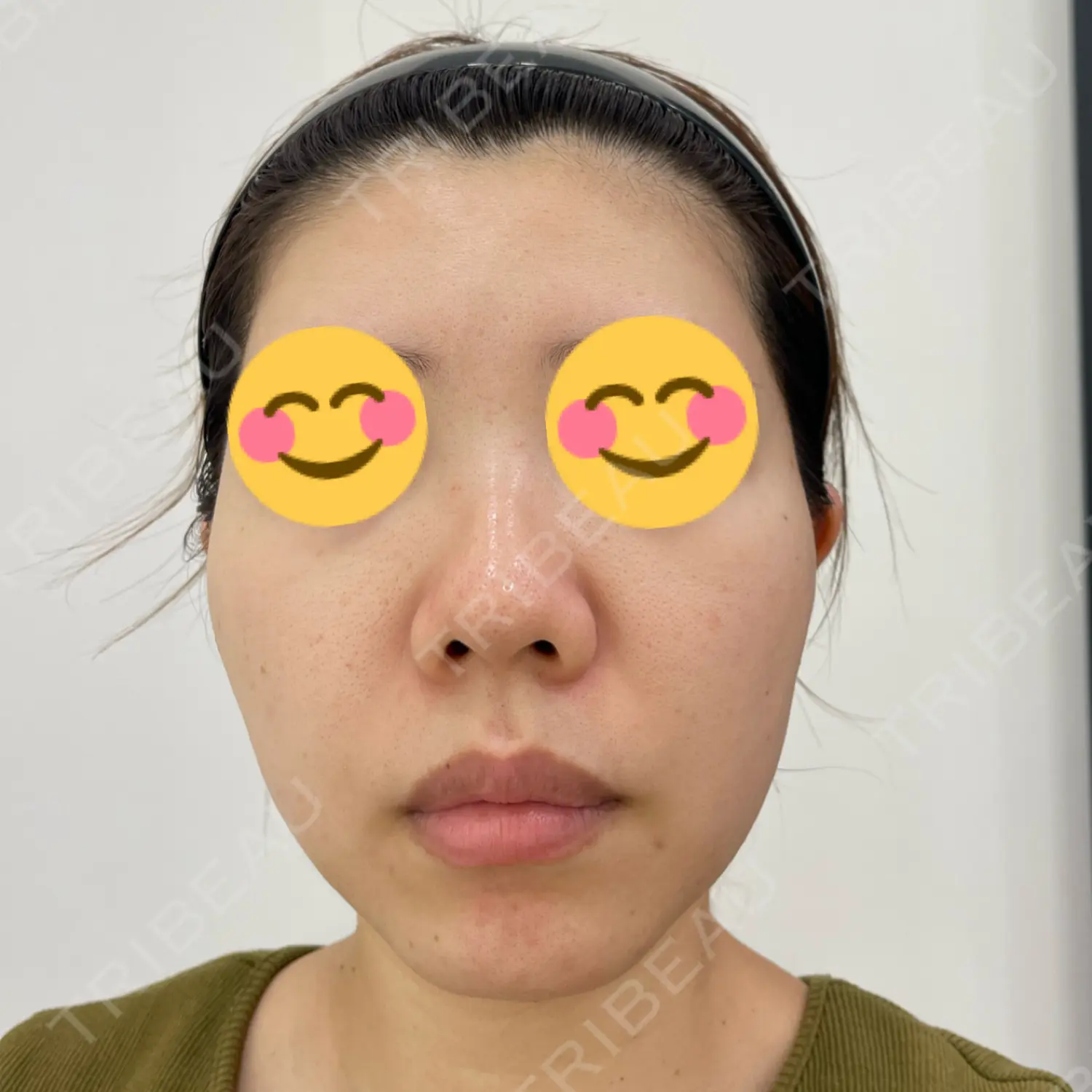 施術前の写真