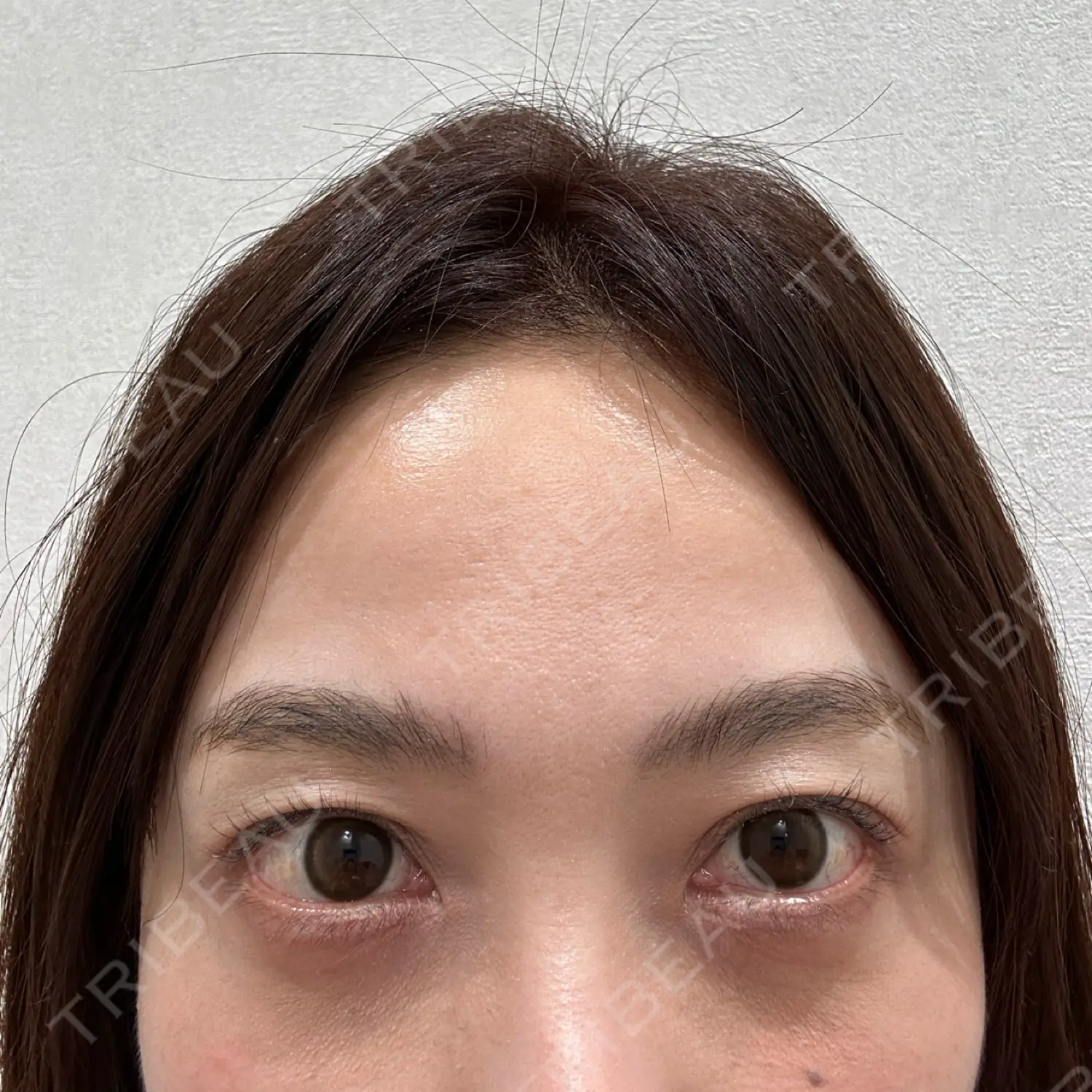施術前の写真