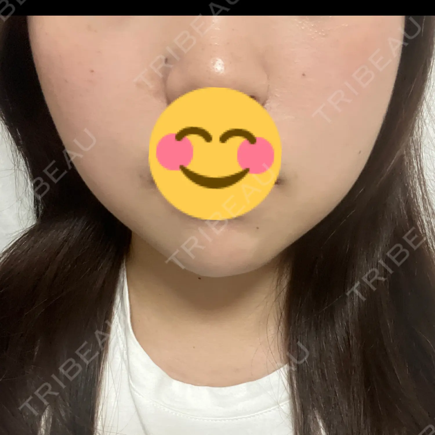 施術前の写真