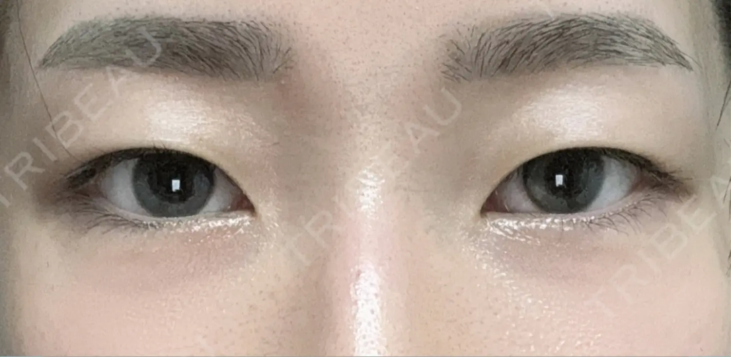施術前の写真