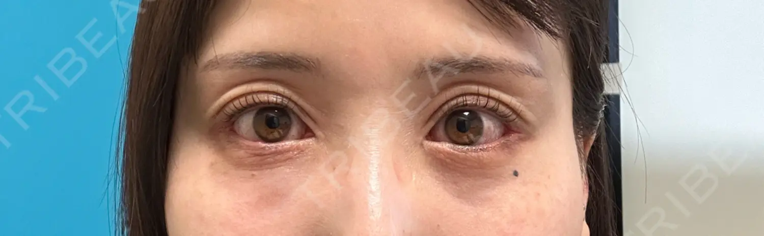 施術前の写真