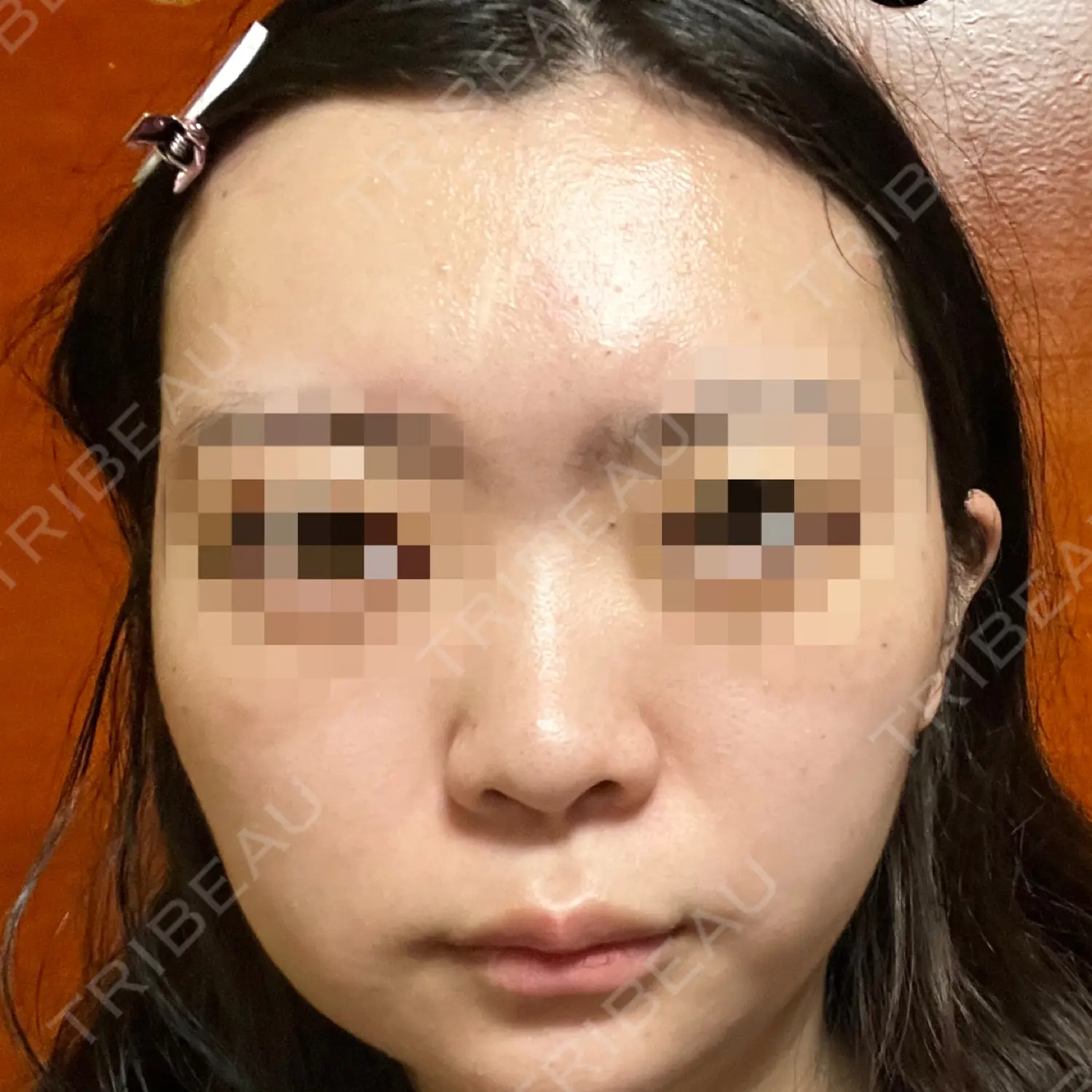 施術前の写真