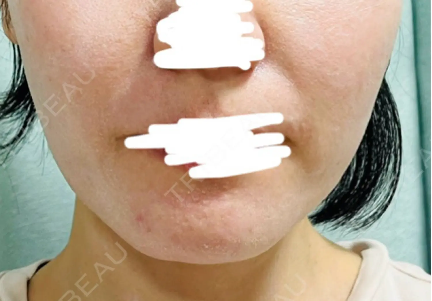 施術前の写真