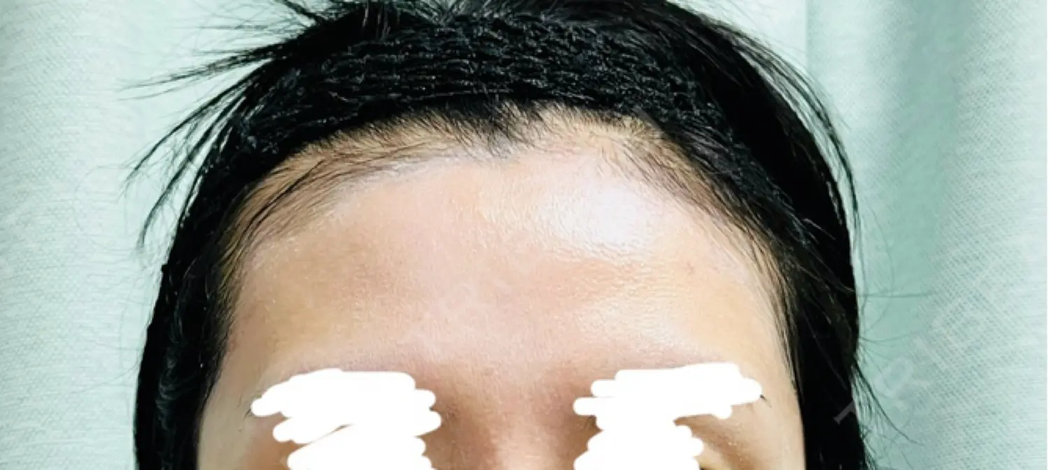 施術前の写真