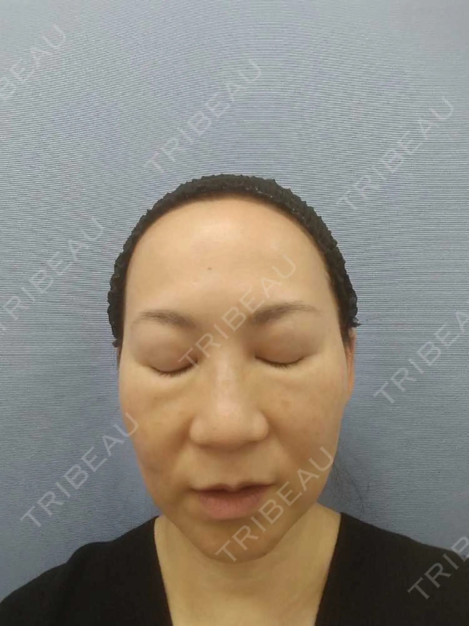 施術前の写真