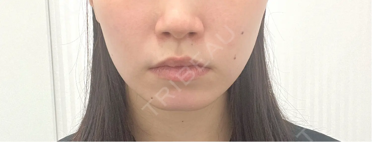 施術前の写真