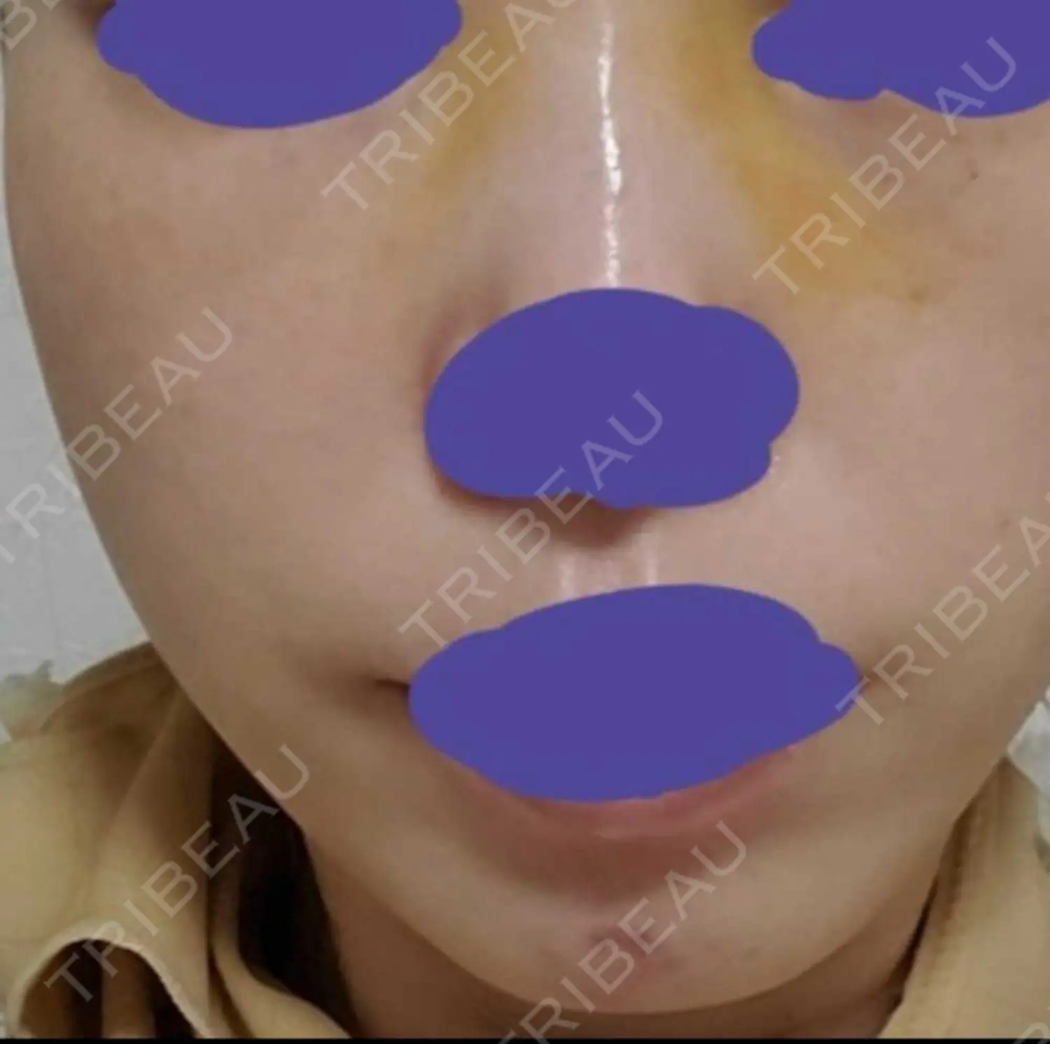 施術前の写真