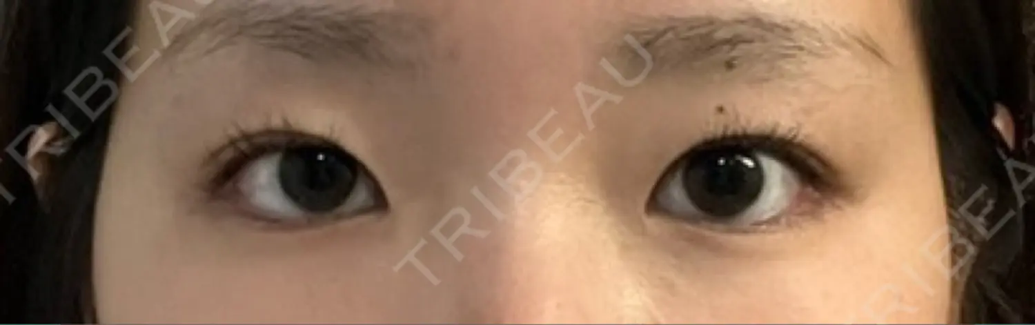 施術前の写真