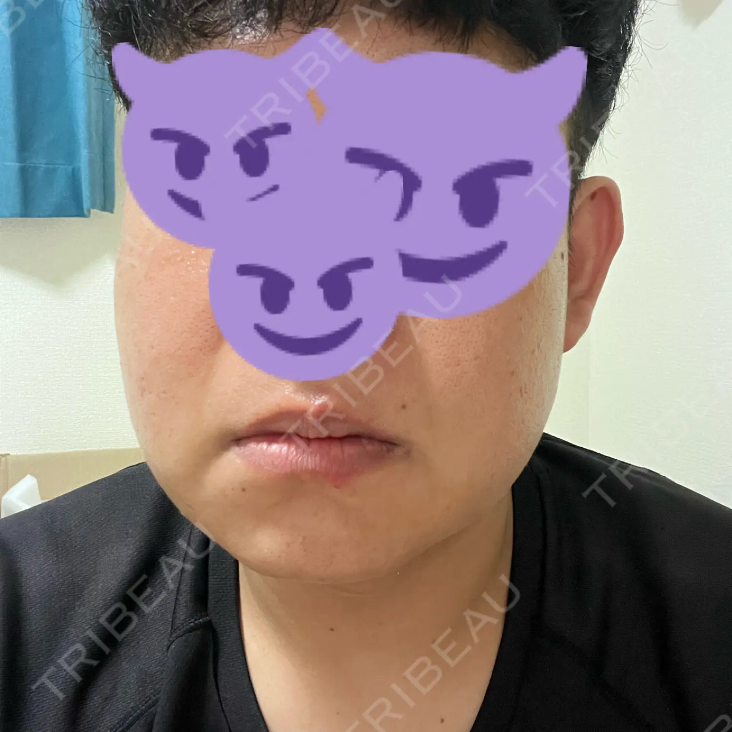 施術前の写真