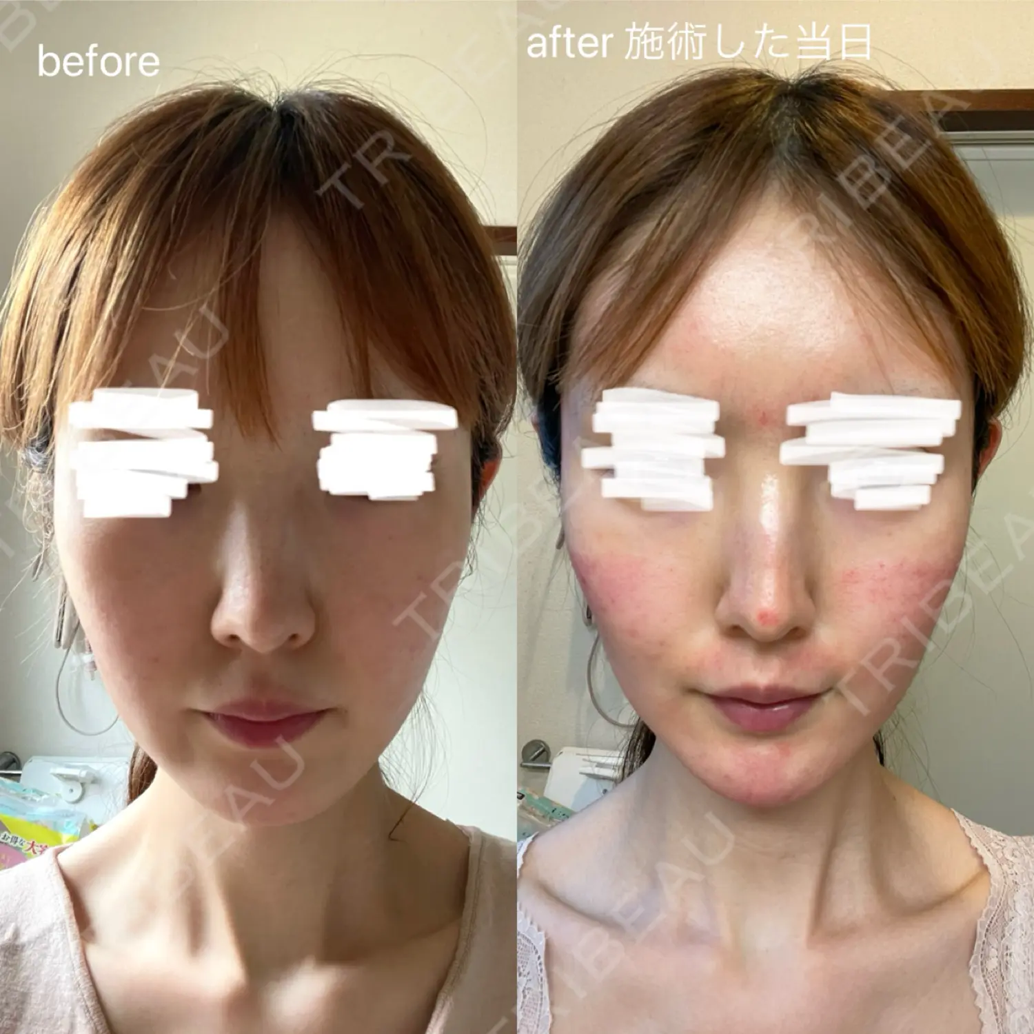 施術前の写真