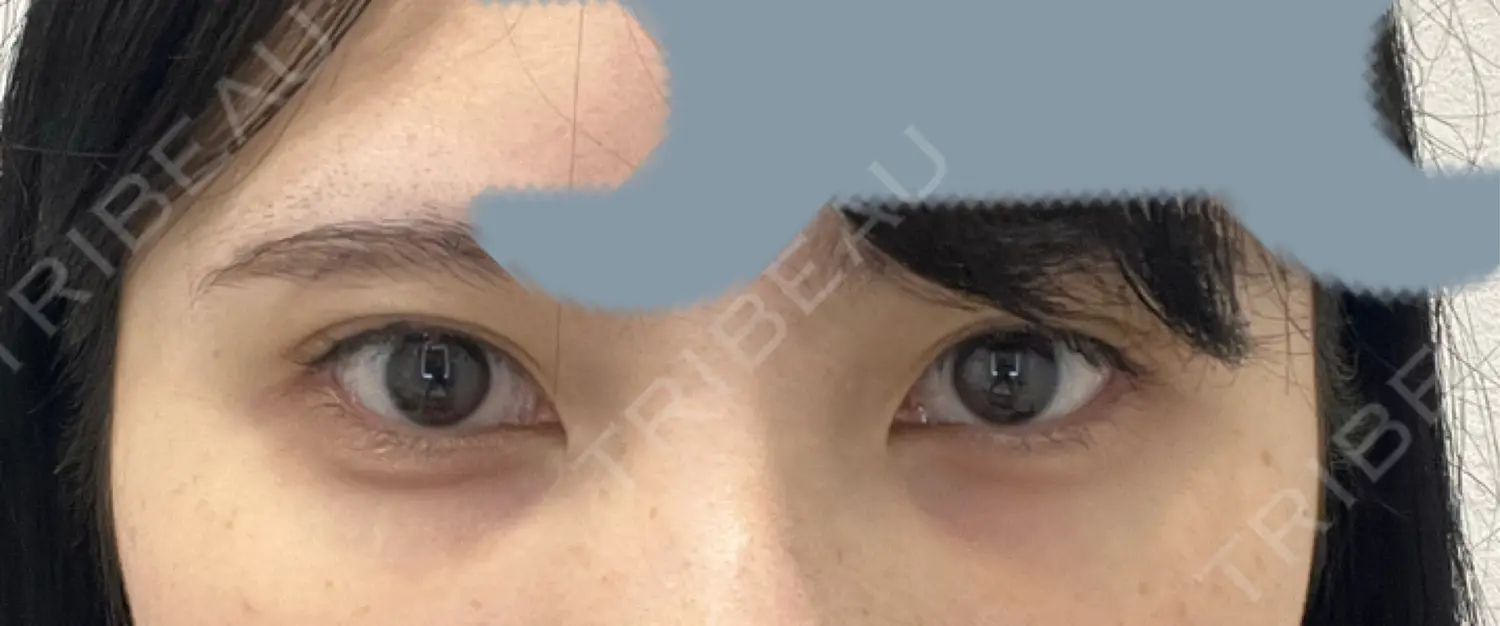 施術前の写真