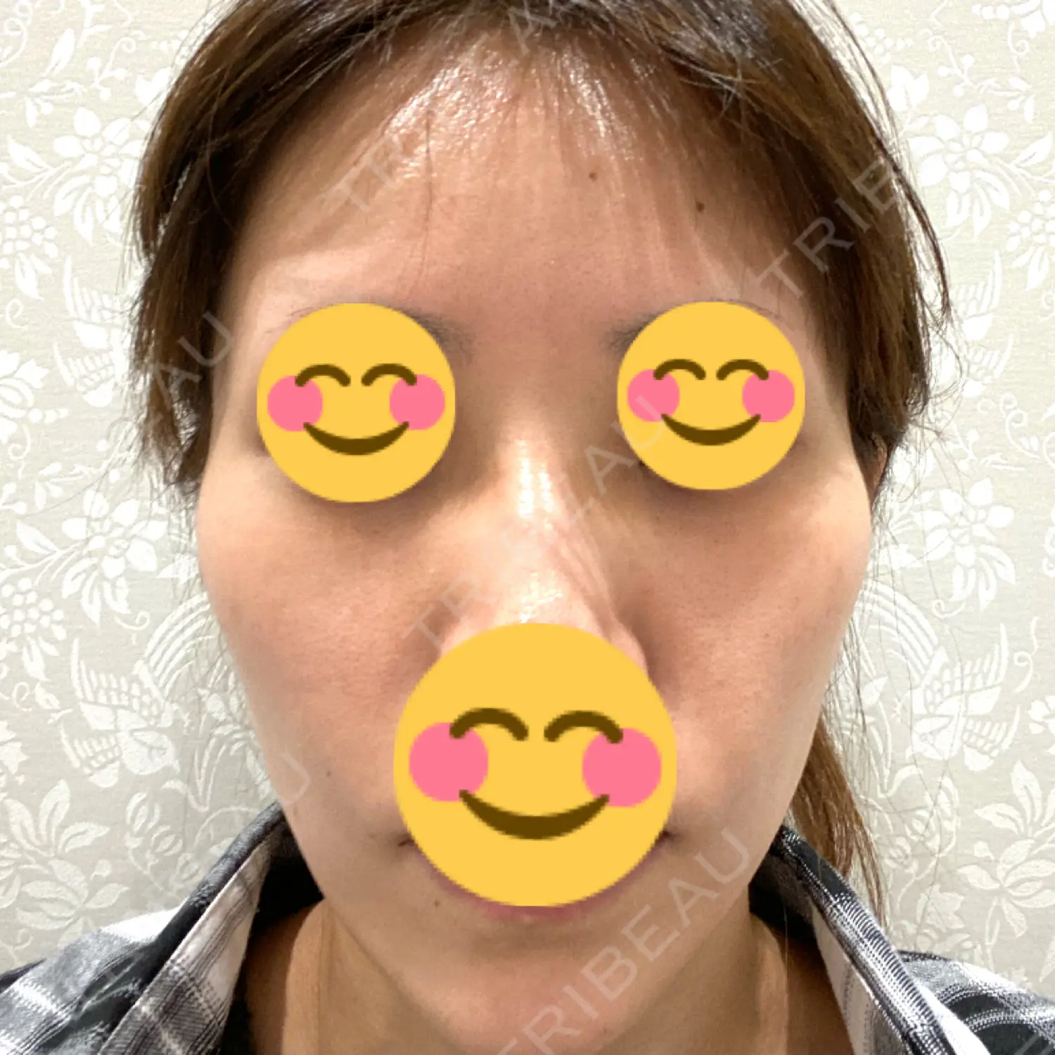 施術前の写真