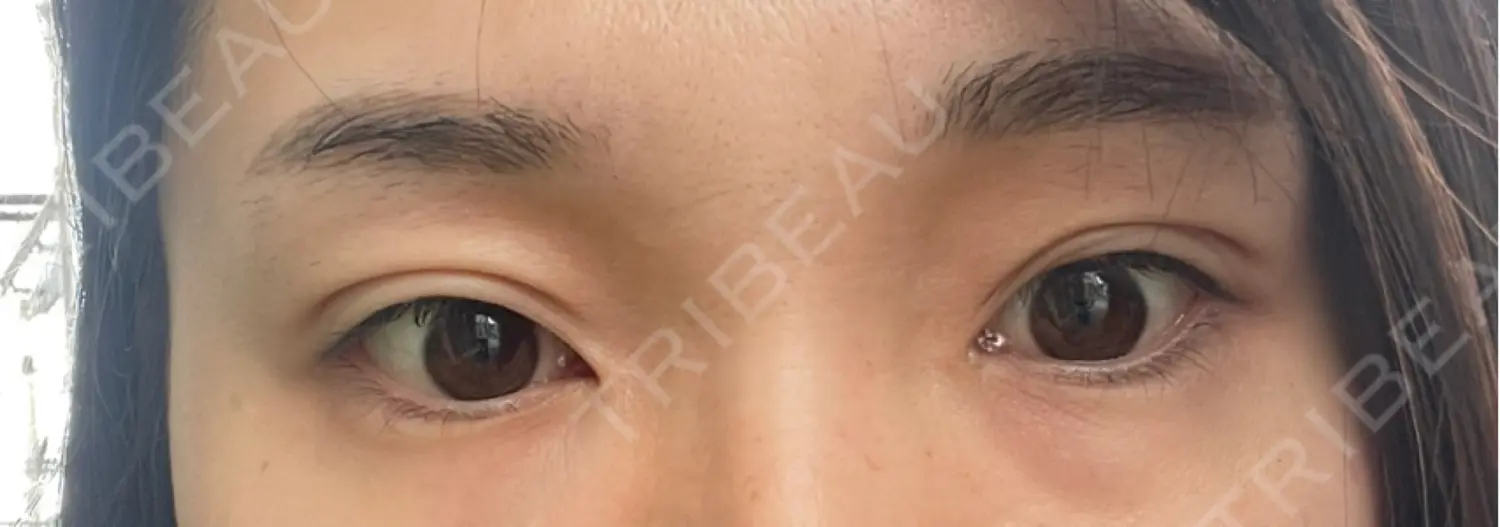 施術前の写真