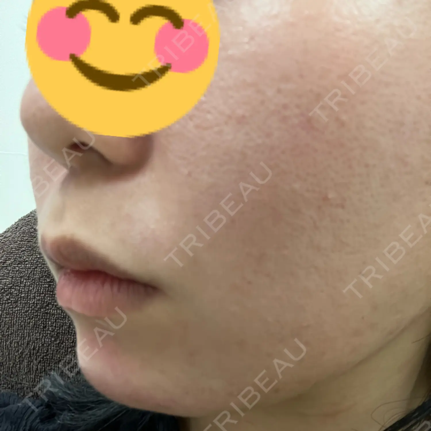 施術前の写真