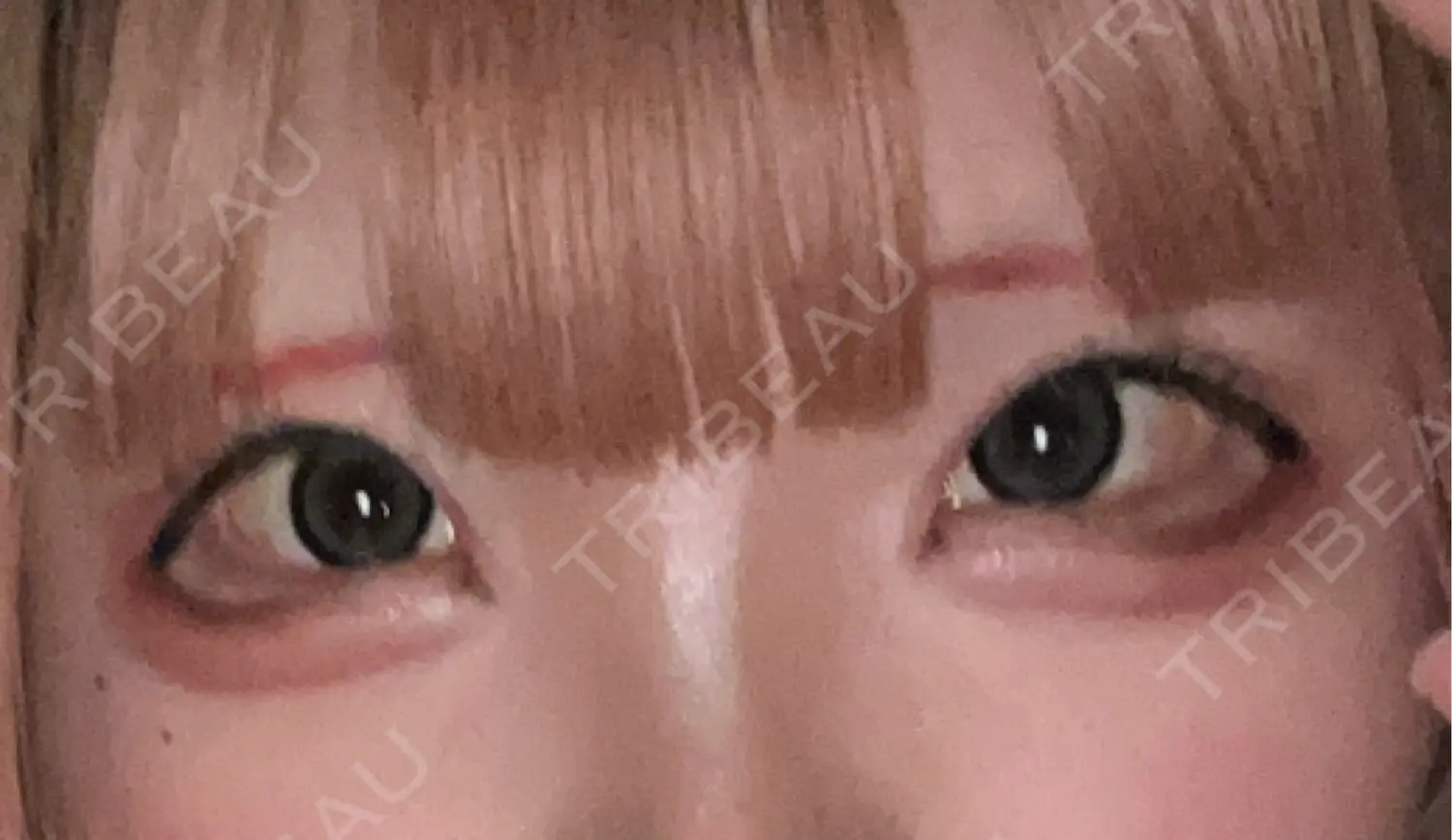 施術前の写真