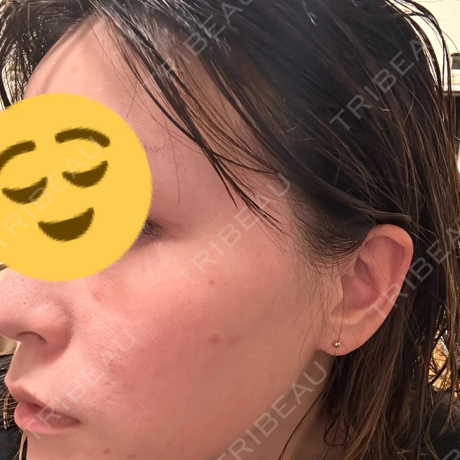 施術前の写真