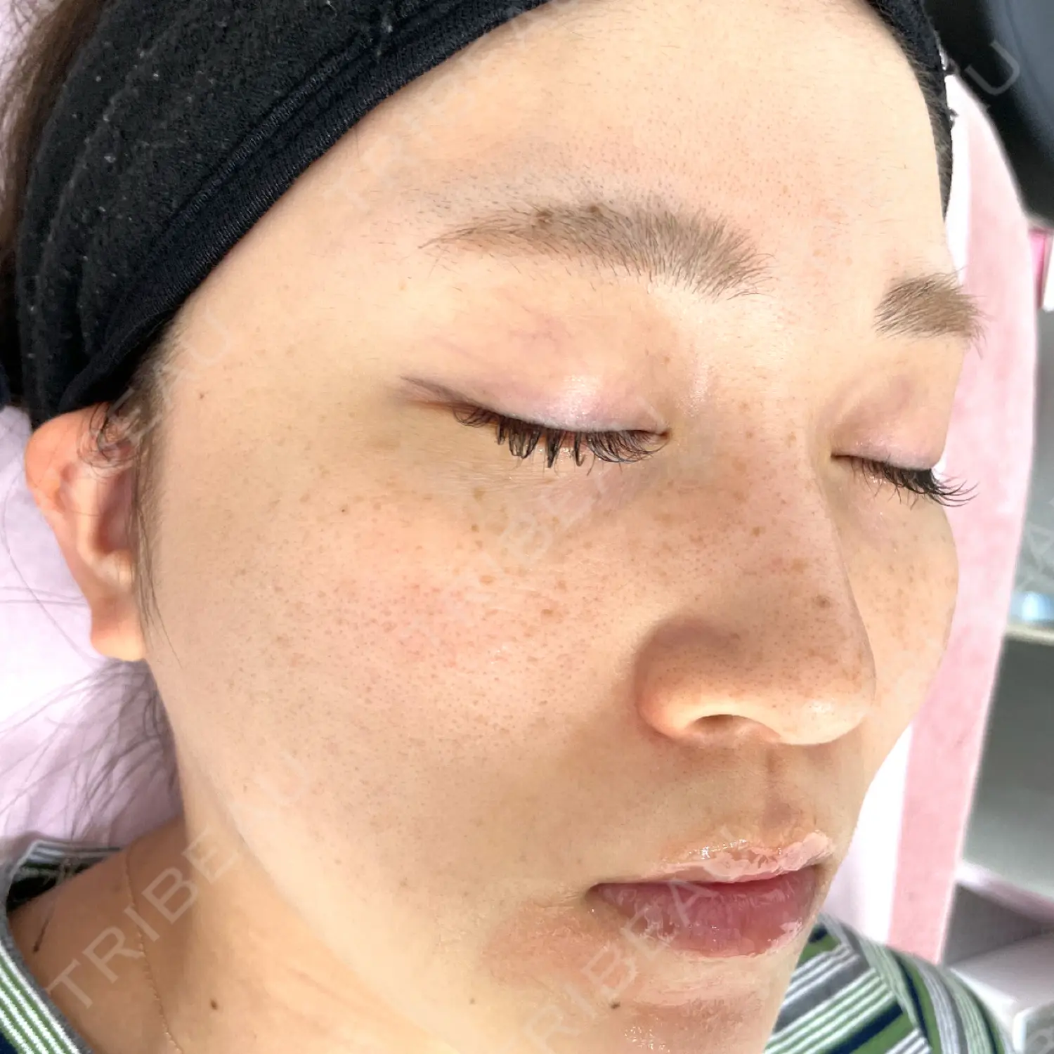 施術前の写真