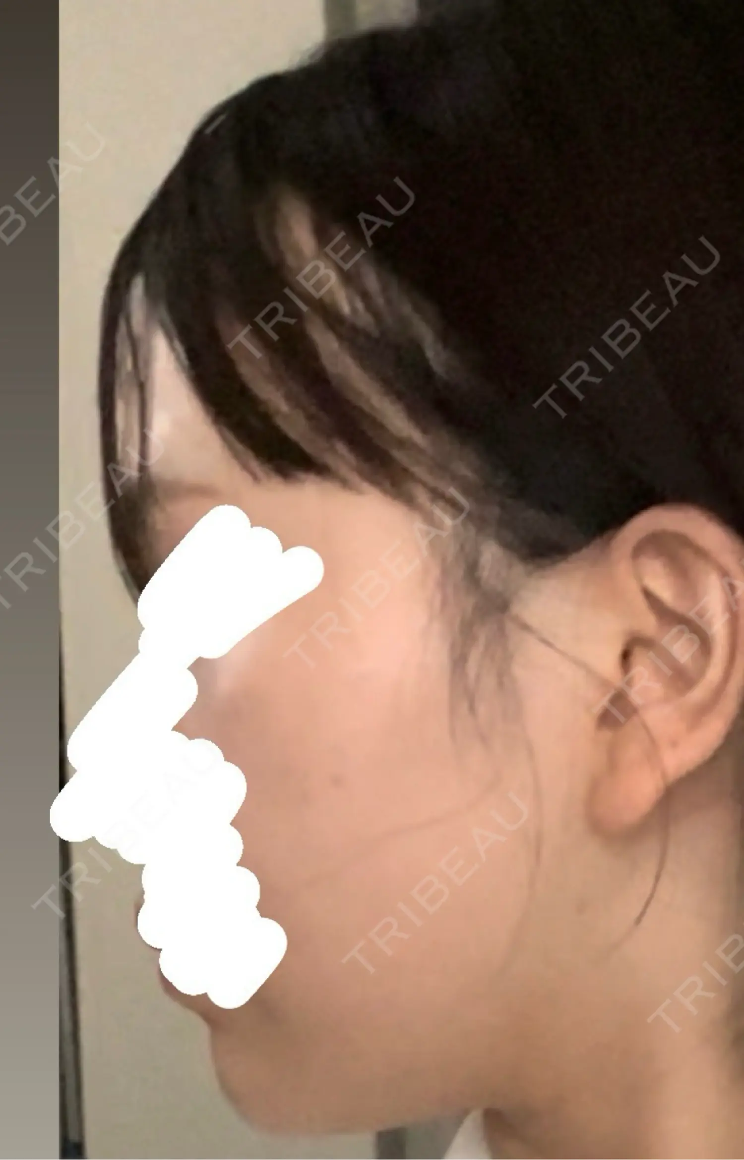 施術前の写真