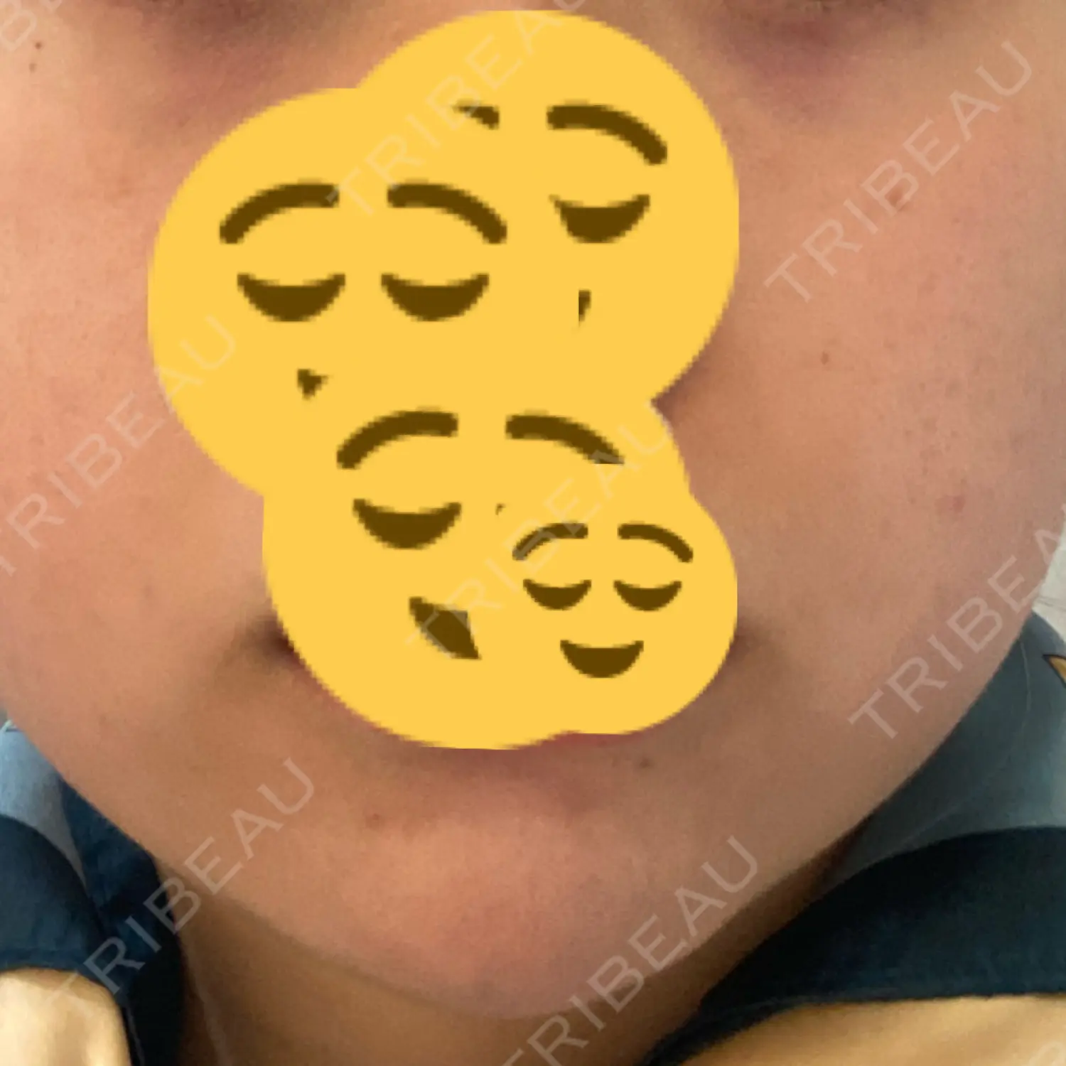 施術前の写真