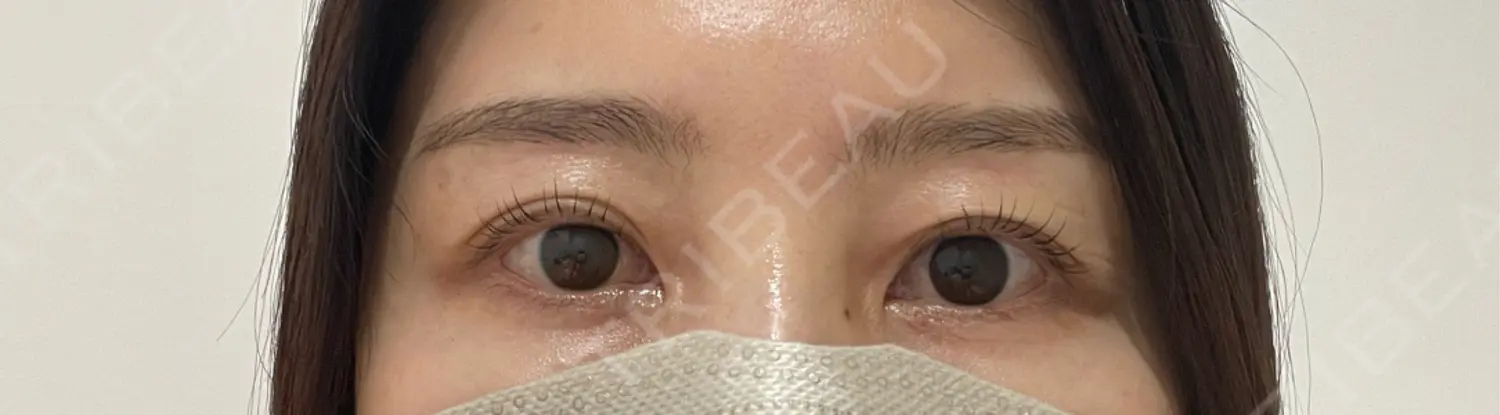 施術前の写真