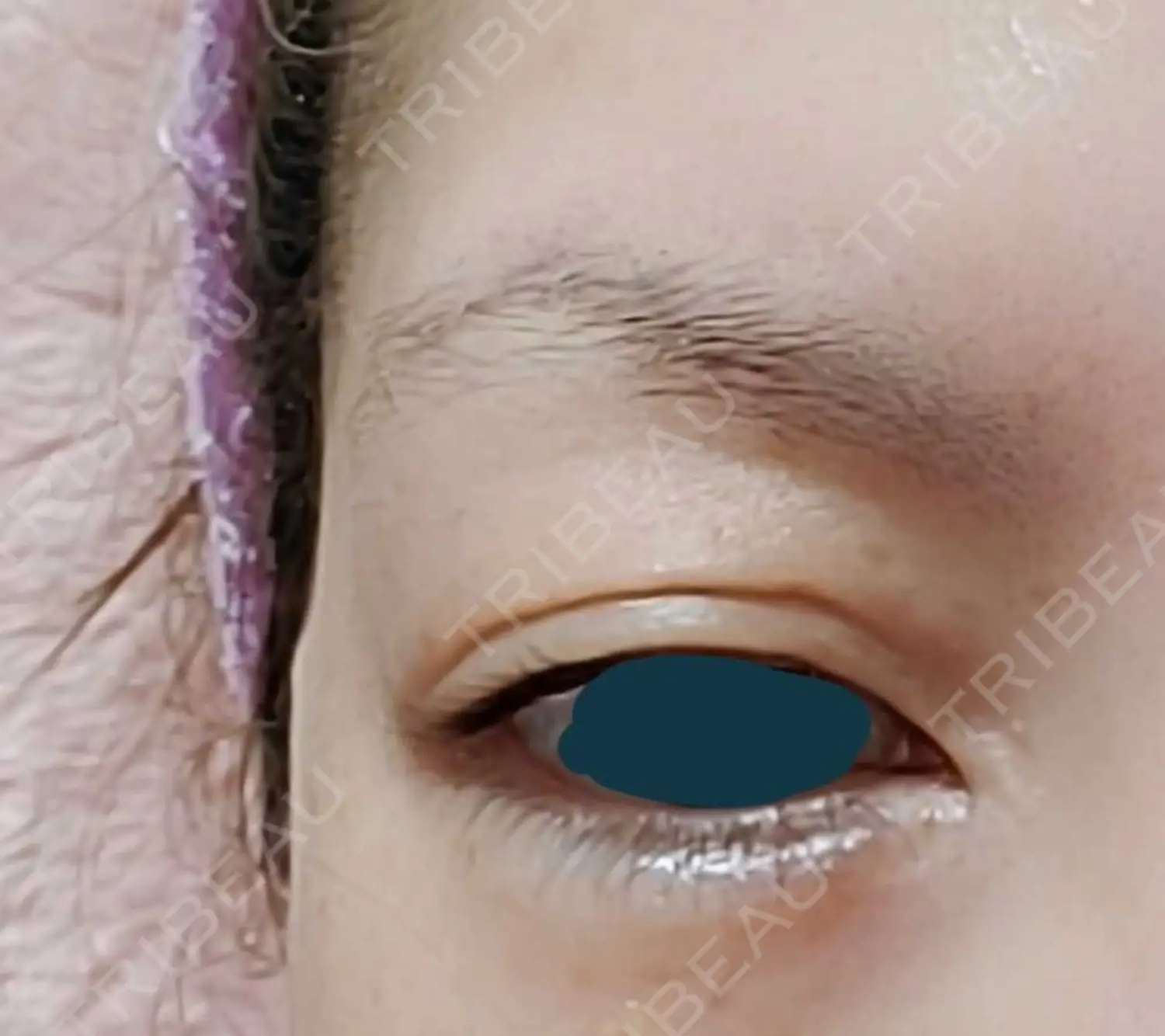 施術前の写真
