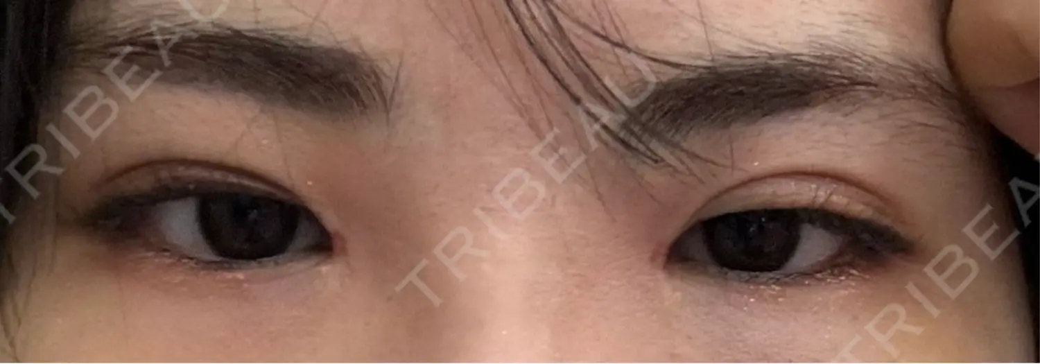 施術前の写真