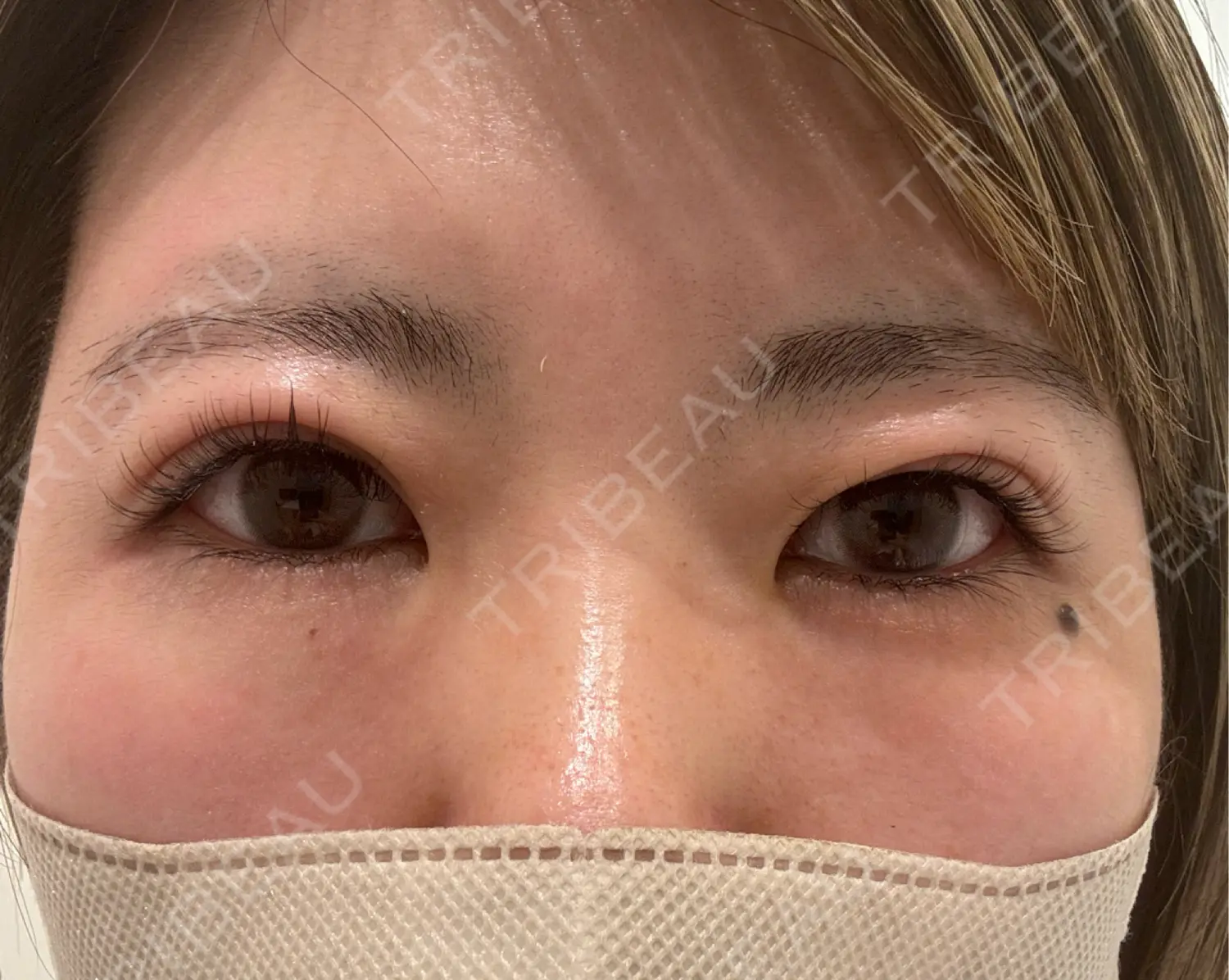 施術前の写真