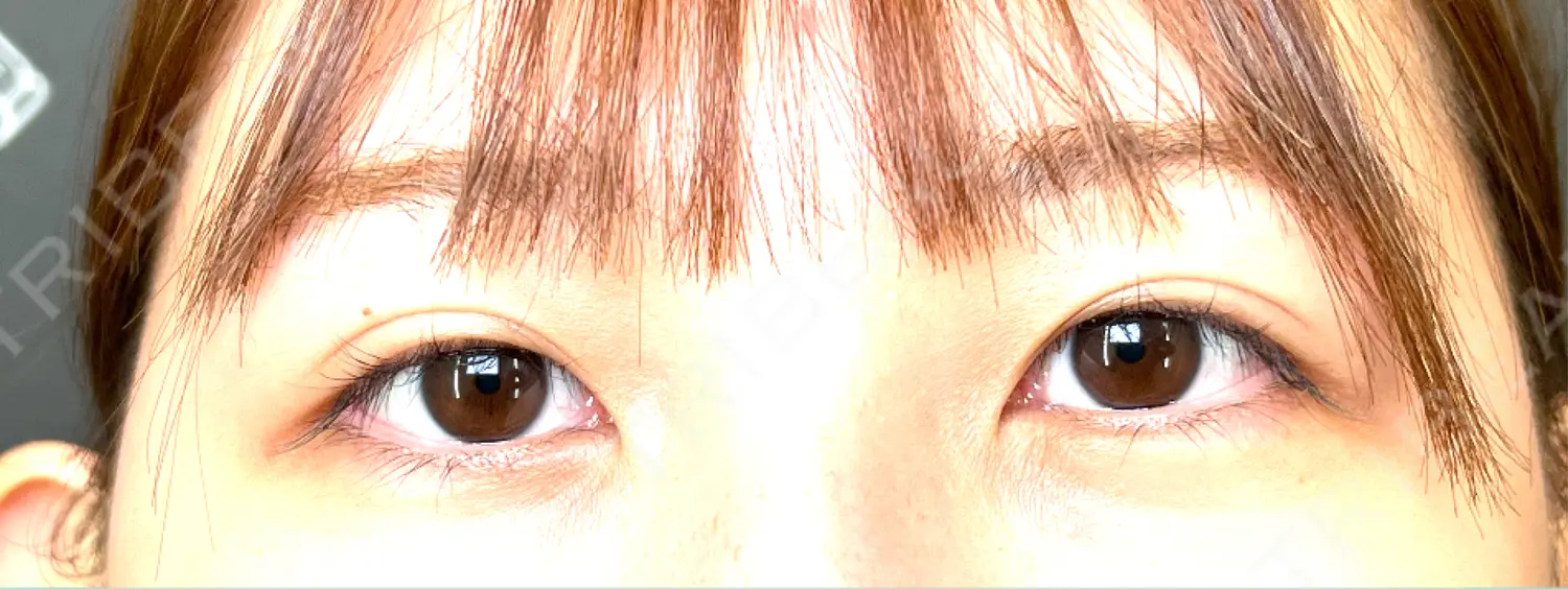施術前の写真