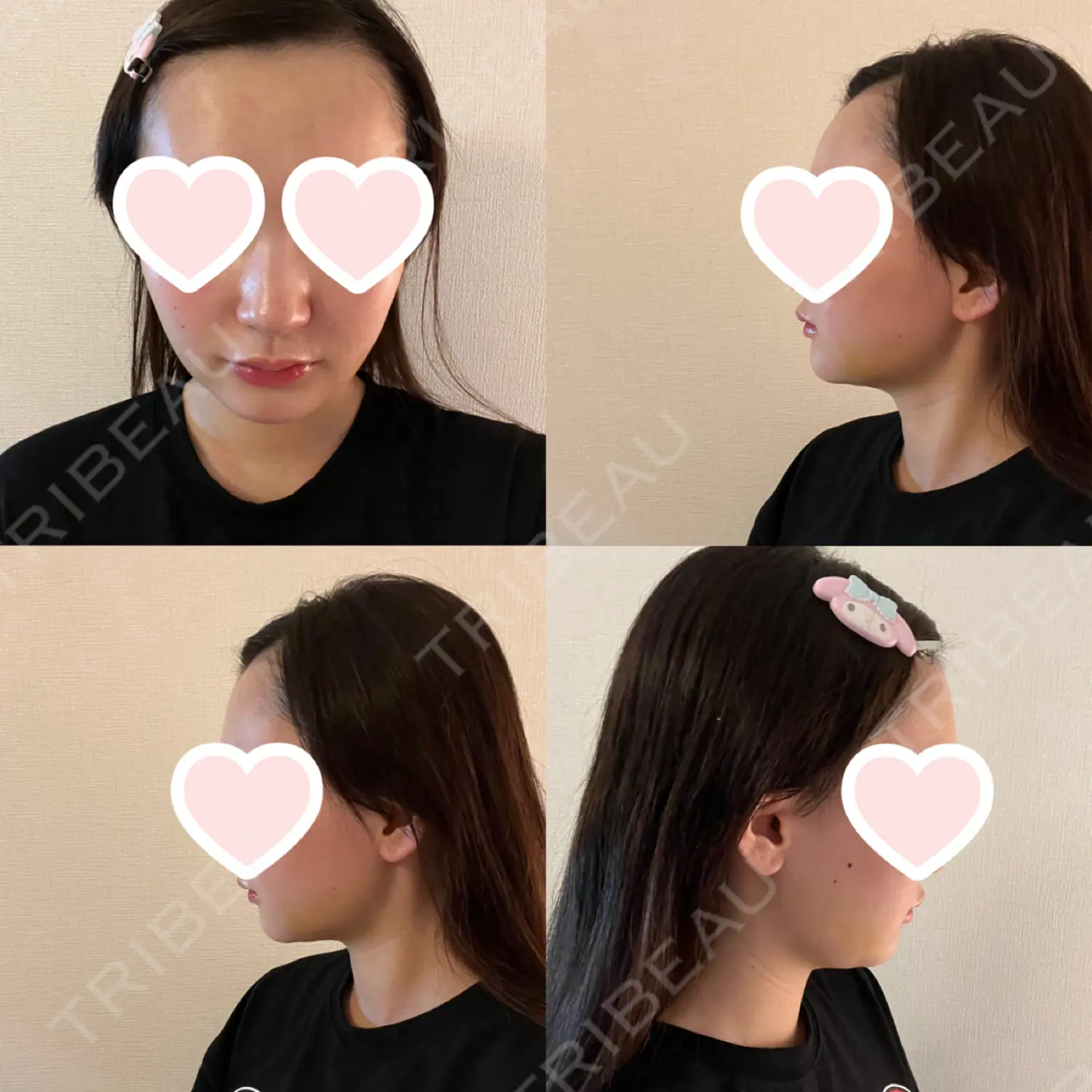施術前の写真