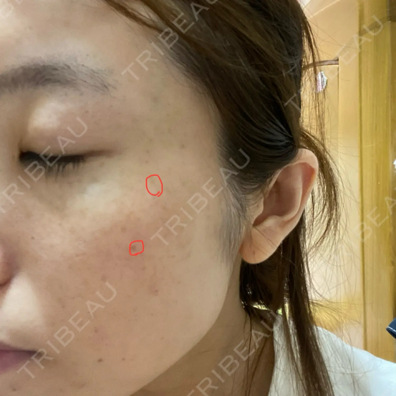 施術前の写真