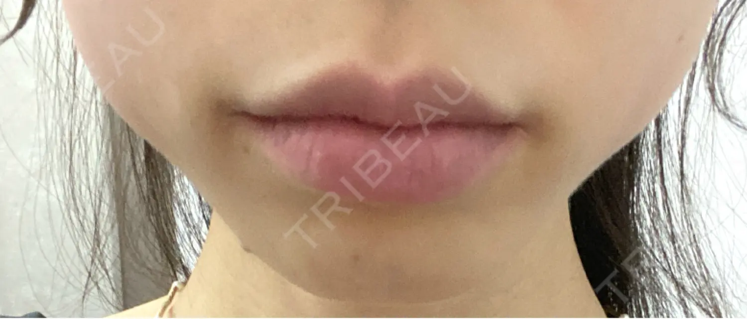 施術前の写真