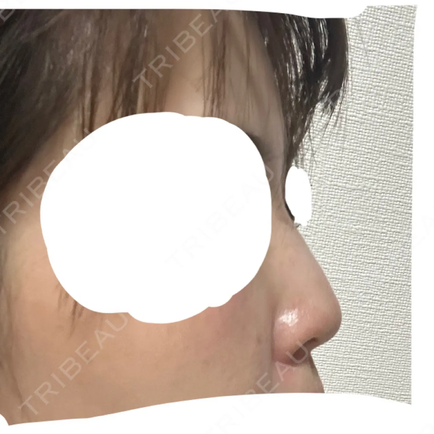 施術前の写真