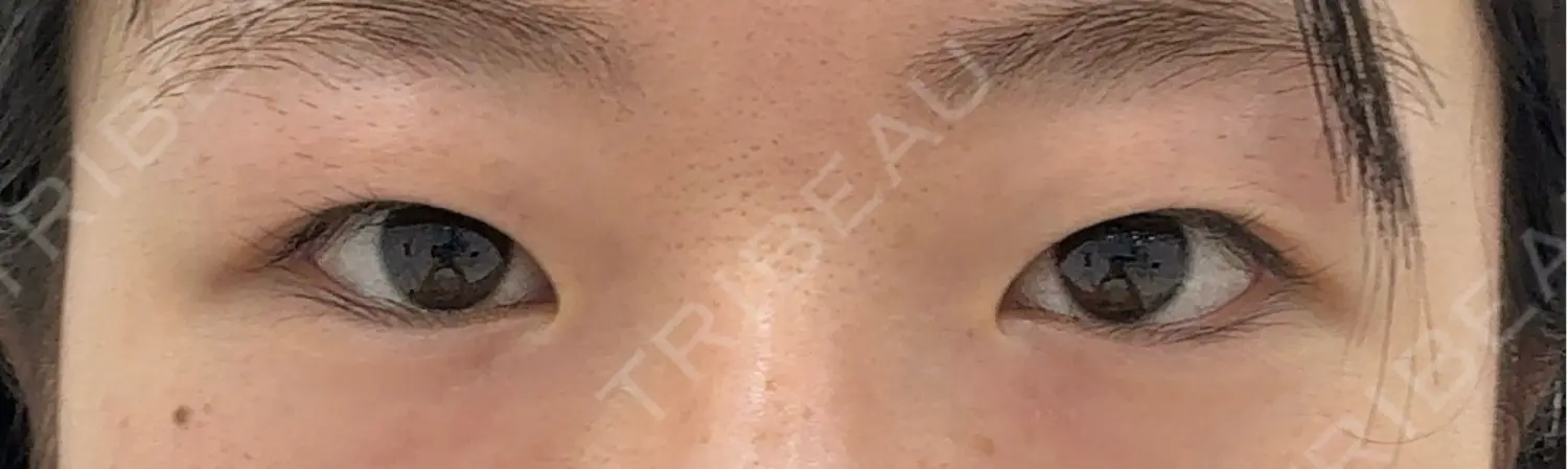 施術前の写真