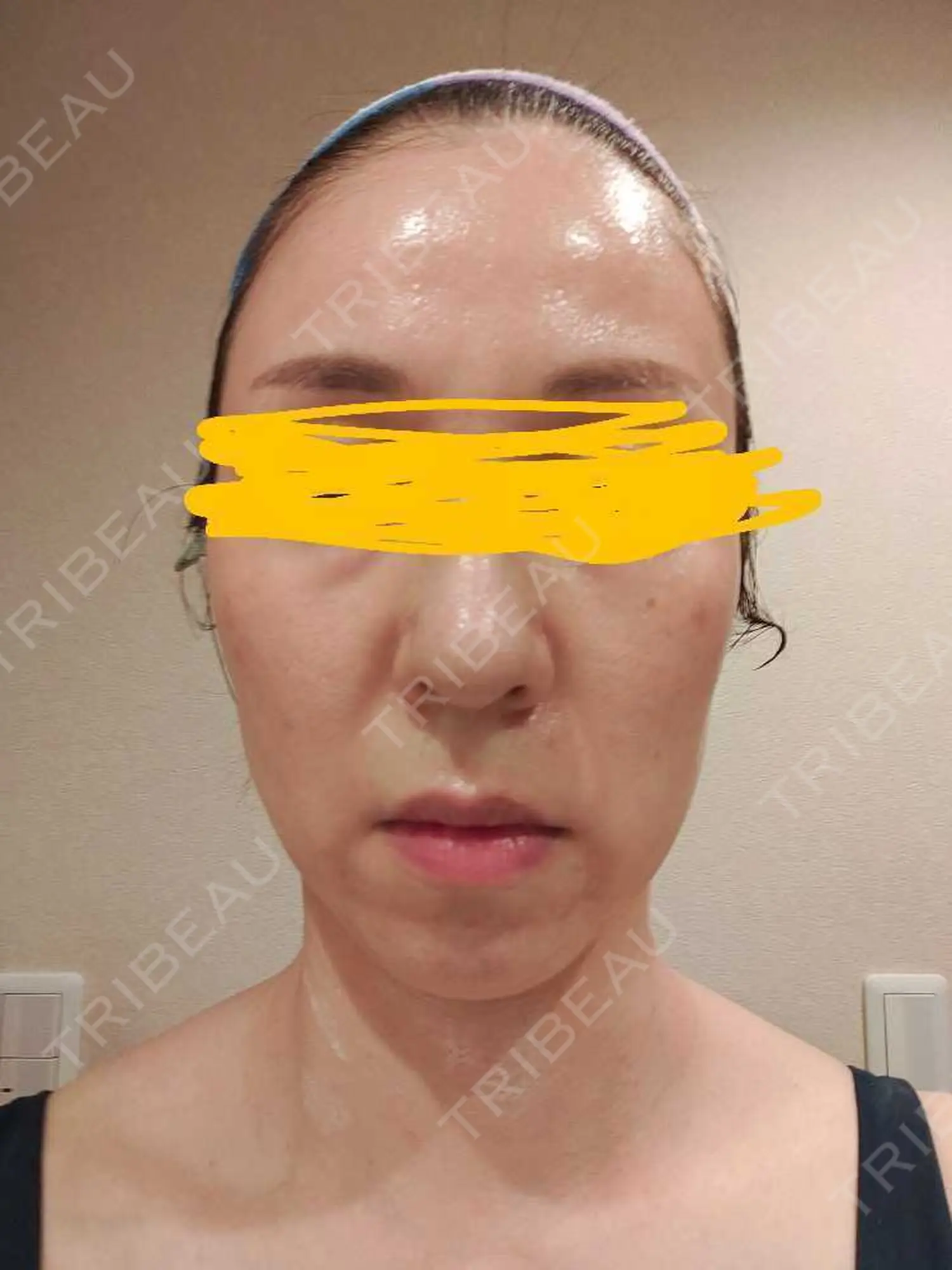 施術前の写真