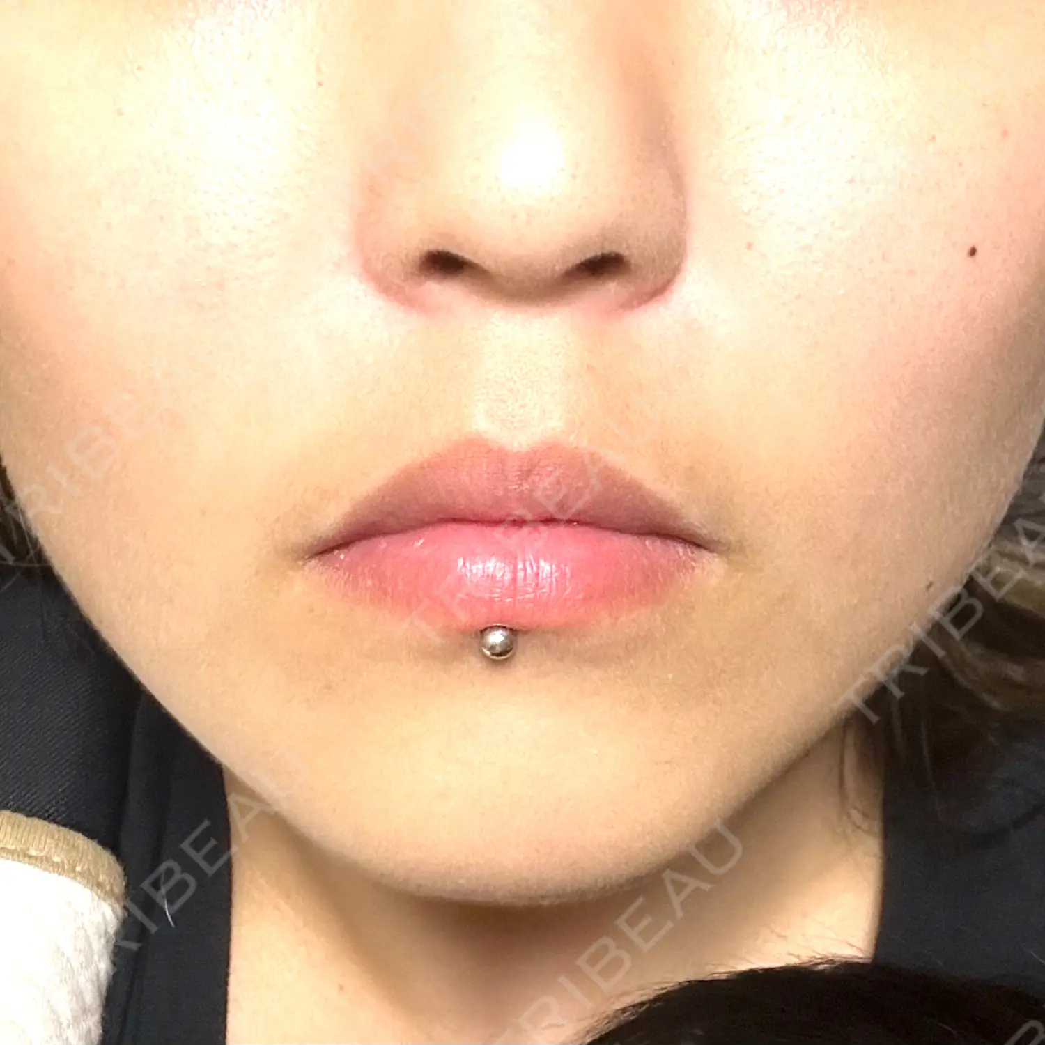 施術前の写真