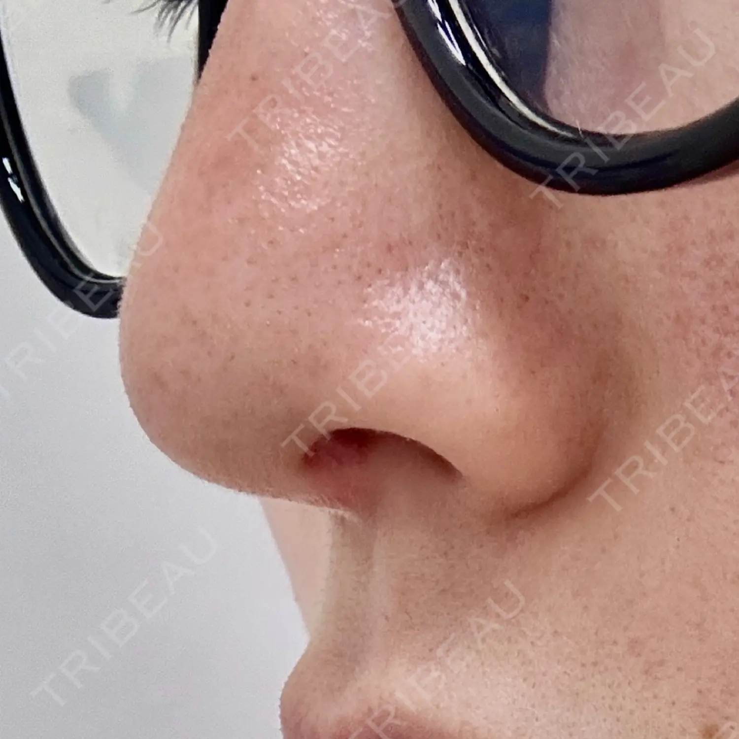 施術前の写真