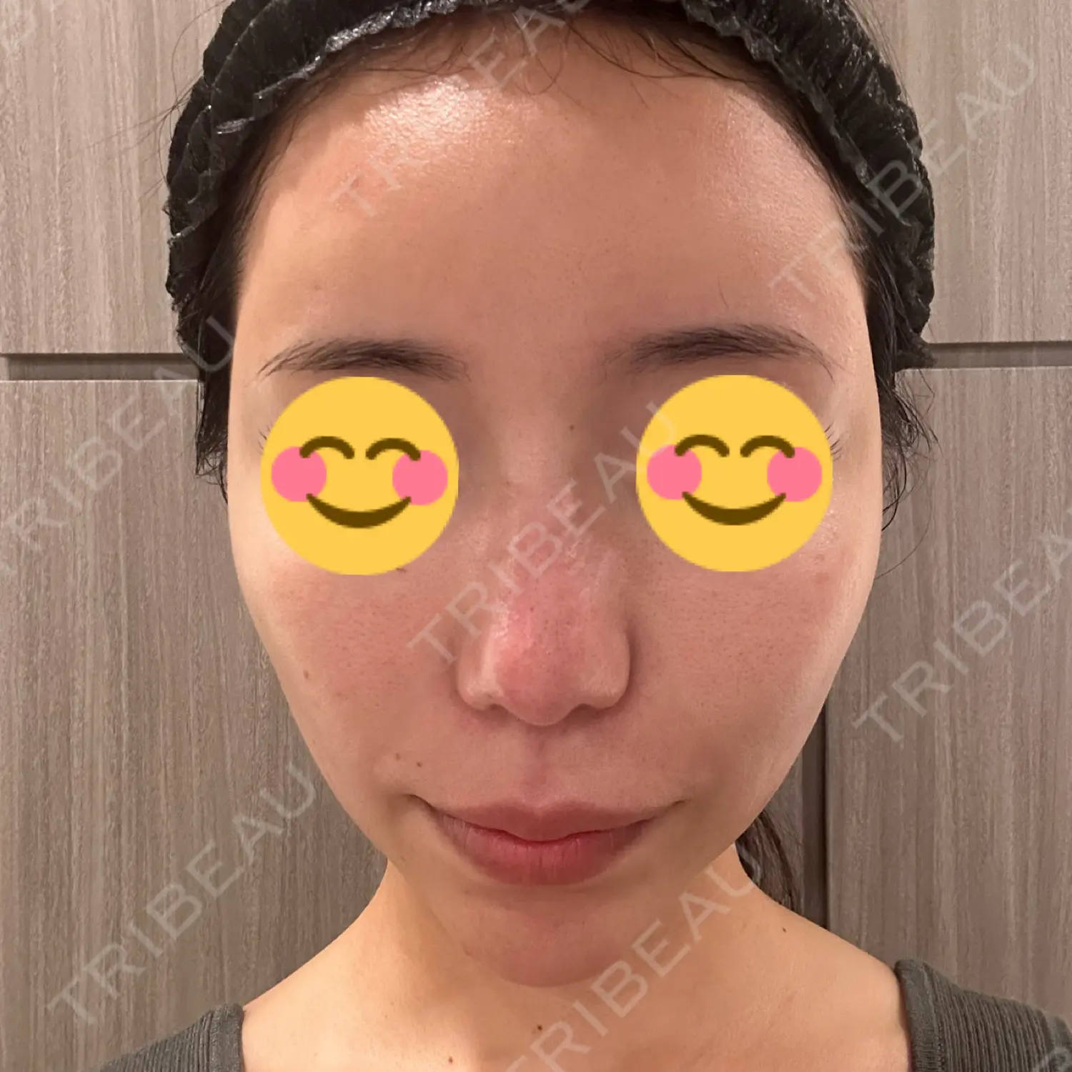 施術前の写真