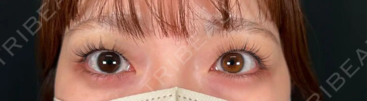 施術前の写真