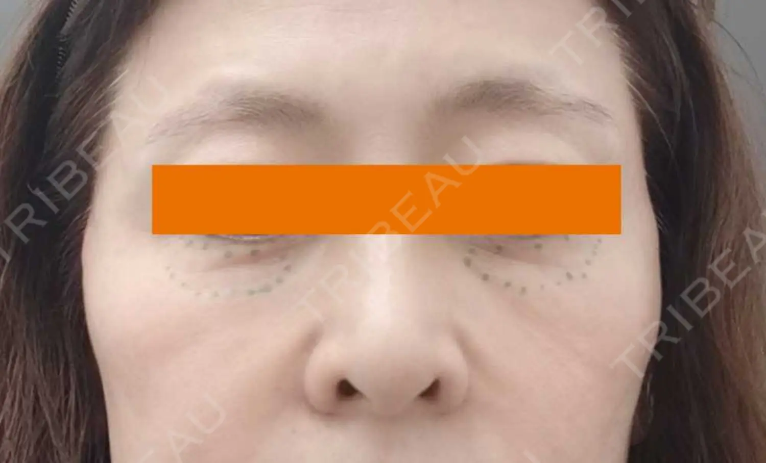 施術前の写真