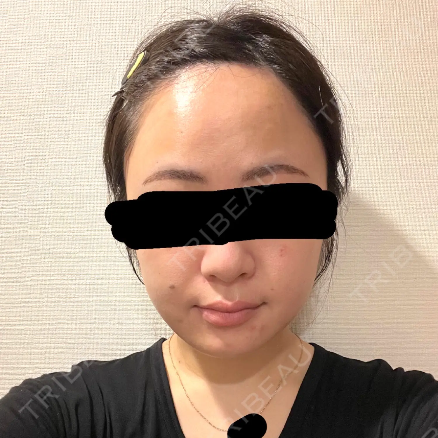 施術前の写真