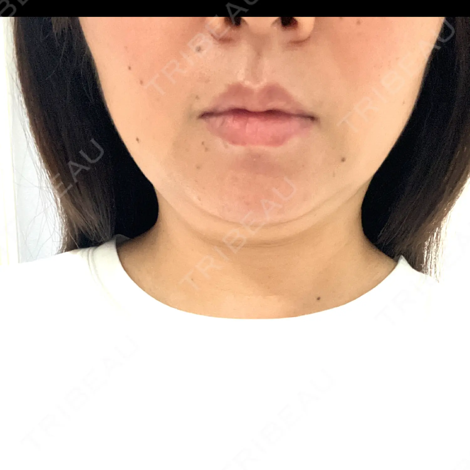 施術前の写真