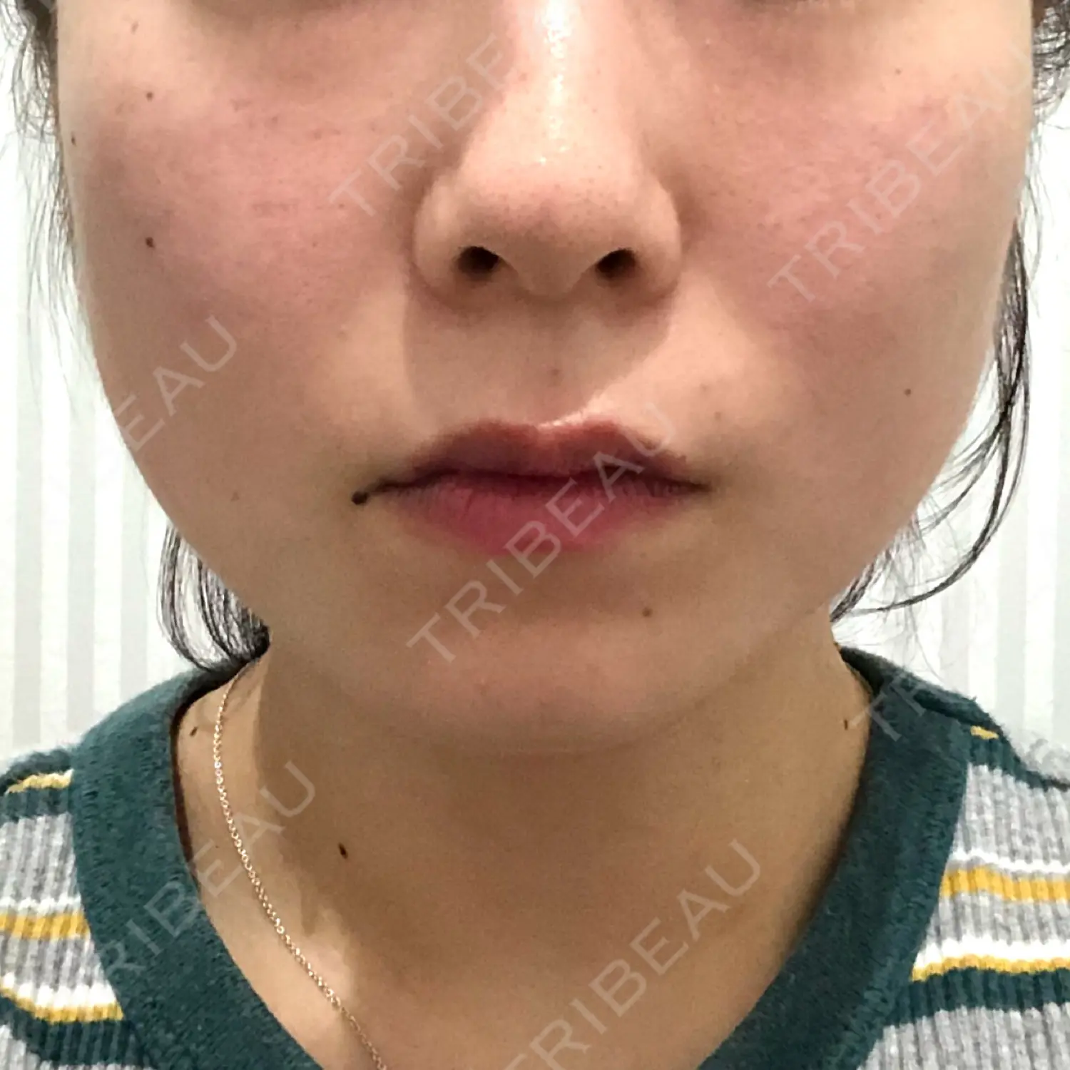 施術前の写真