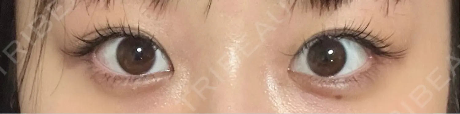 施術前の写真