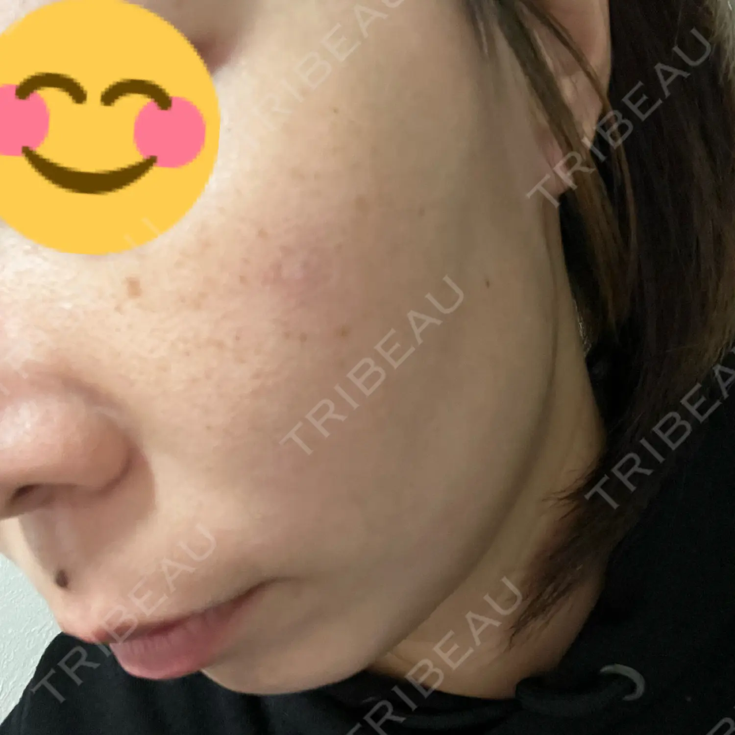 施術前の写真