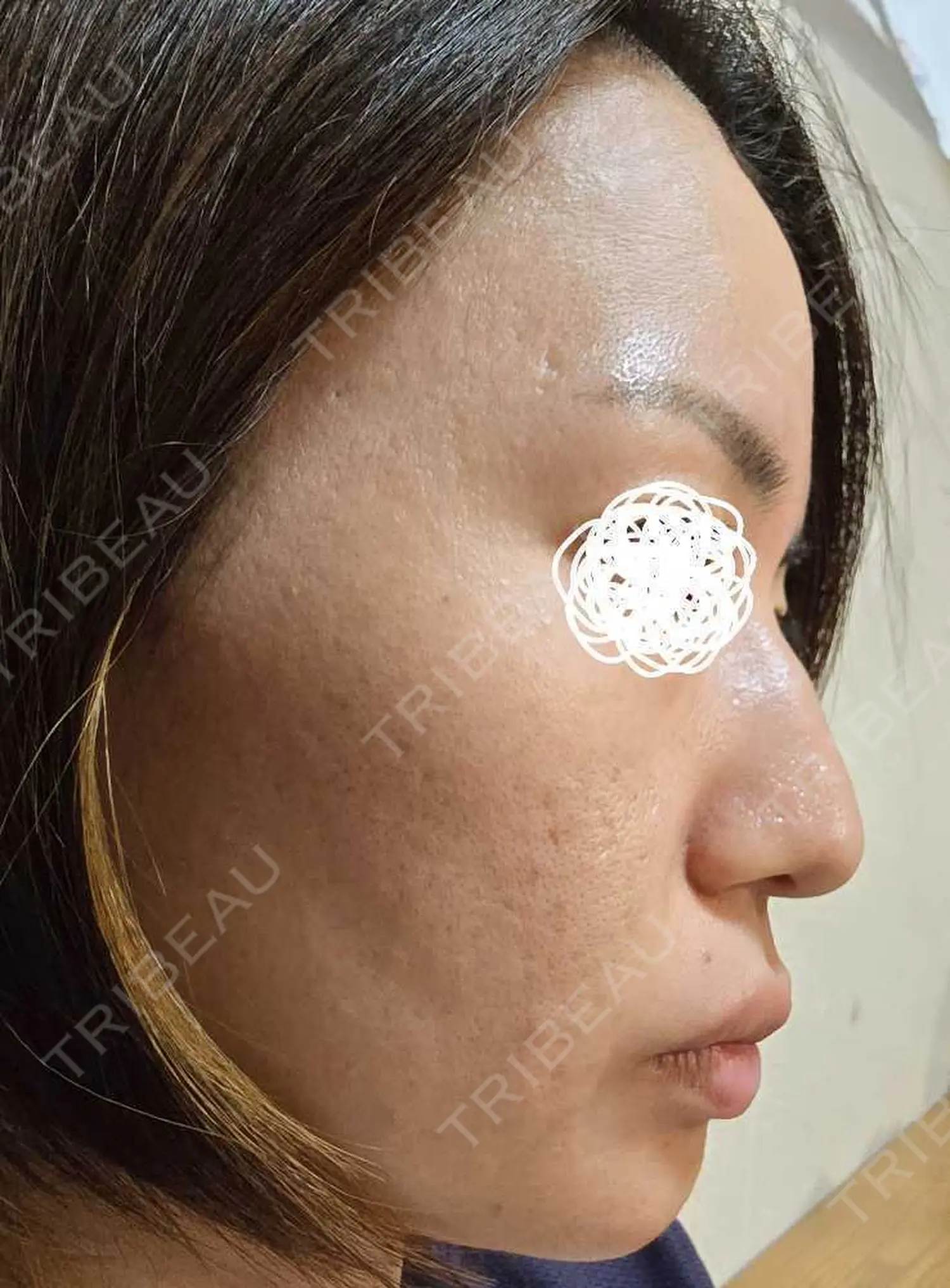 施術前の写真